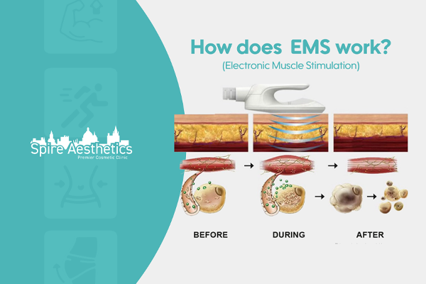 EMS treatment for post pregnancy weight loss treatment Leighton Buzzard