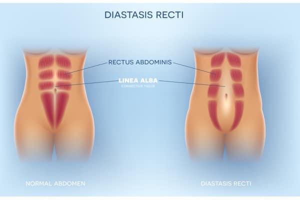 What Non-Surgical Options Are Available for Diastasis Recti Leighton Buzzard?