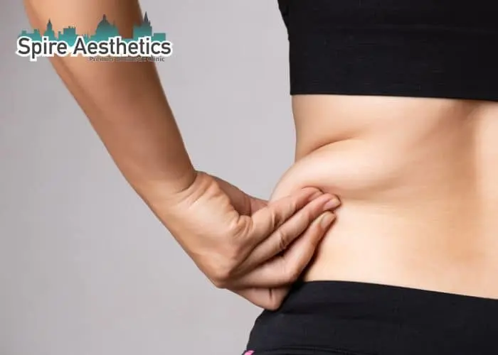 Image of woman pinching fat on their hips Leighton Buzzard. Fat Freezing treatment