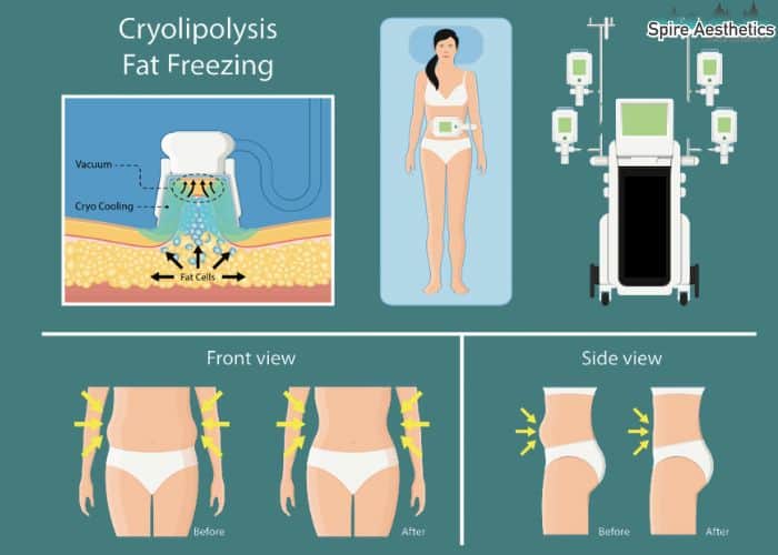 Image of diet and fat freezing combined for best results for Spire Aesthetics Leighton Buzzard