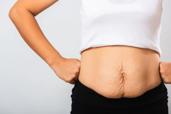 Image of a woman's stomach after weight loss with sagging skin following a gastric band Leighton Buzzard