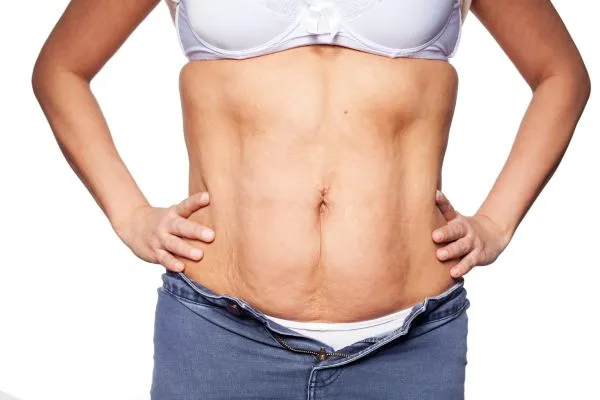 sagging skin on woman's stomach after weight loss injections Leighton Buzzard