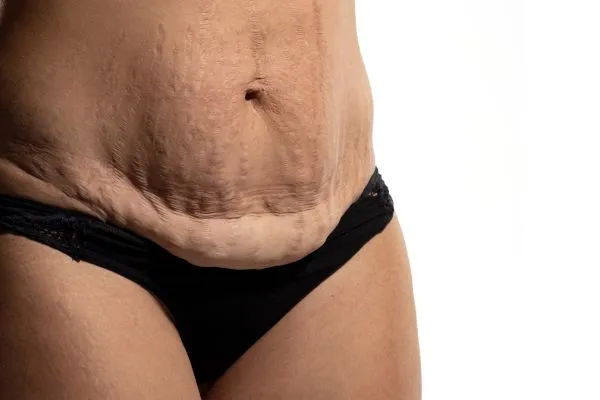 Image of womans stomach after weight loss injections Leighton Buzzard showing saggy skin