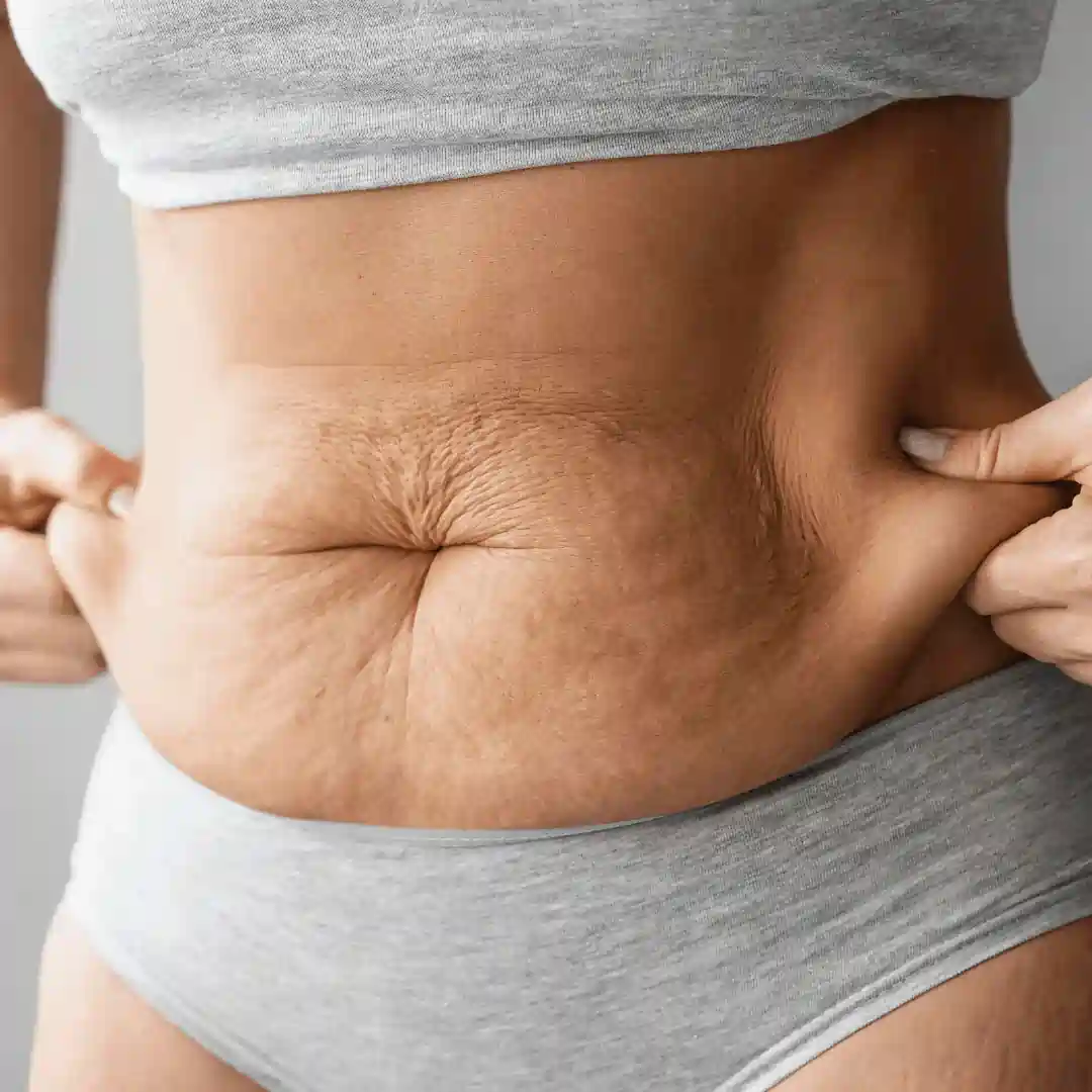 Is It Normal to Have Loose Skin After Pregnancy Leighton Buzzard?