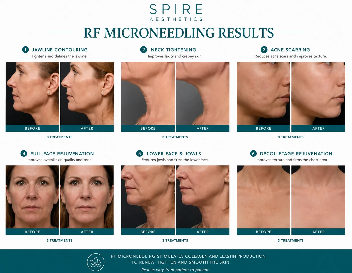 RF Microneedling Skin tightening Leighton Buzzard results