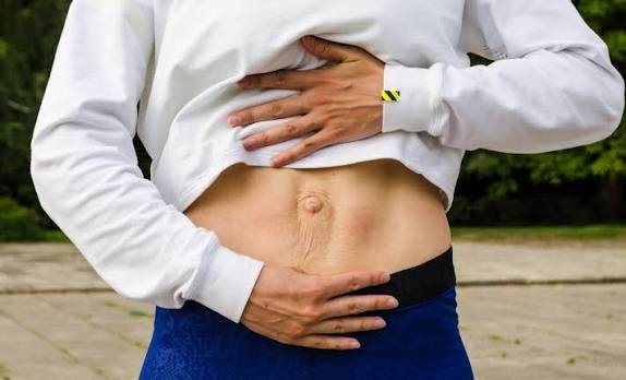 When Could Diastasis Recti Be the Missing Piece of the Puzzle Leighton Buzzard?