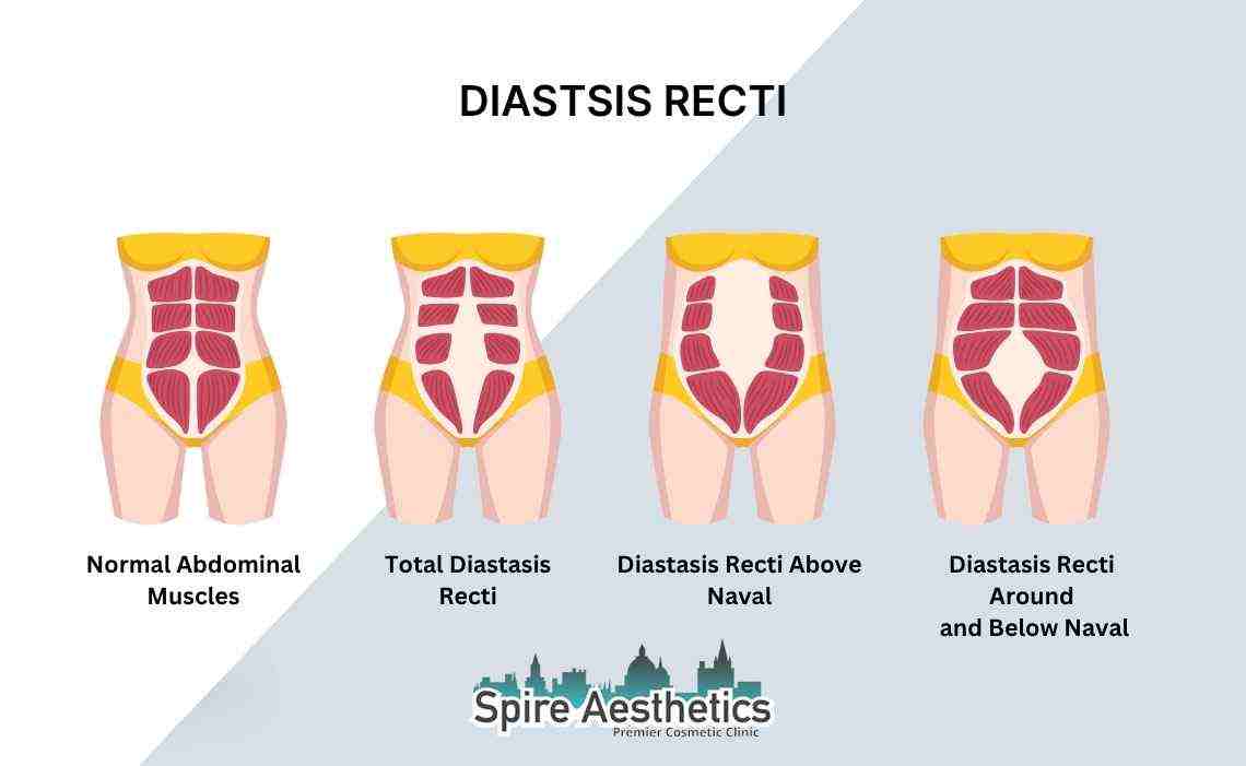 Is Non-Surgical Diastasis Recti Treatment Right for You? Common Concerns Answered Leighton Buzzard